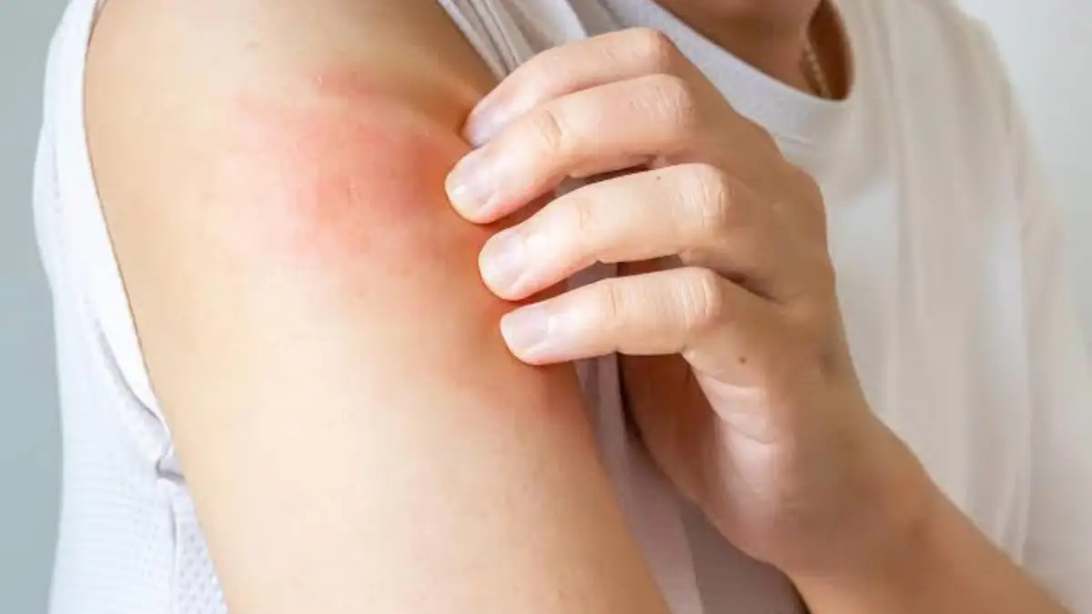 Why scratching an itch makes it worse: Scientists uncover the surprising reason