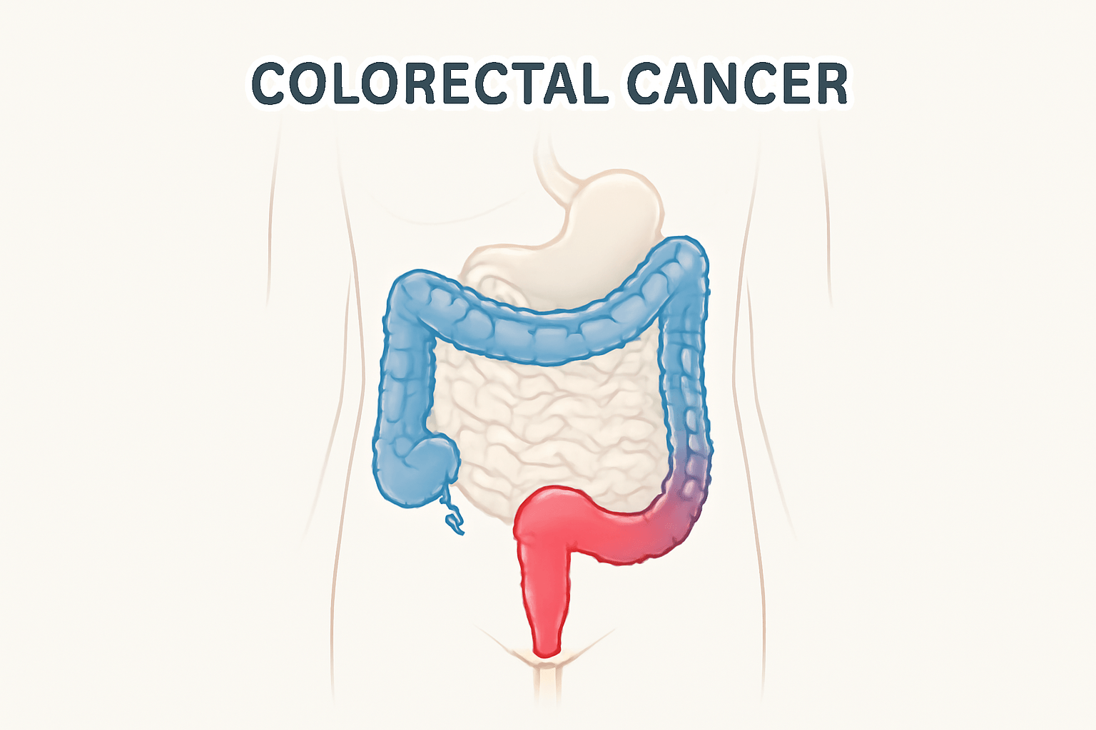 Colorectal Cancer: How Your Diet influences Risk